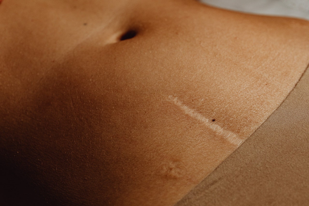 massage post-chirurgie : éviter les adhérences d’une cicatrice