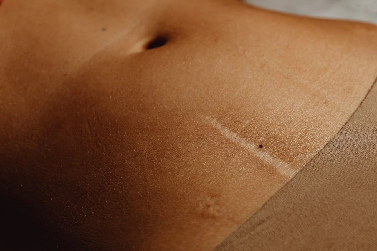 massage post-chirurgie : éviter les adhérences d’une cicatrice